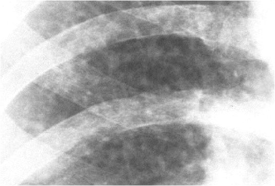 Close-up of a chest x-ray of a worker with silicosis showing many small round spots in the lung